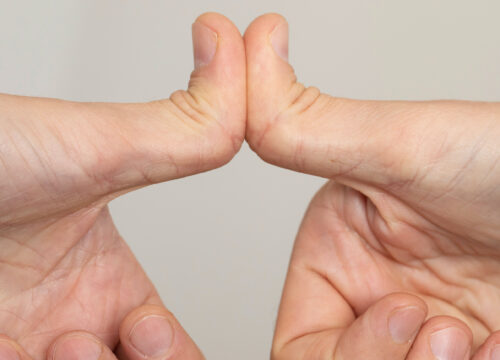 Photo of a person with double-jointed thumbs